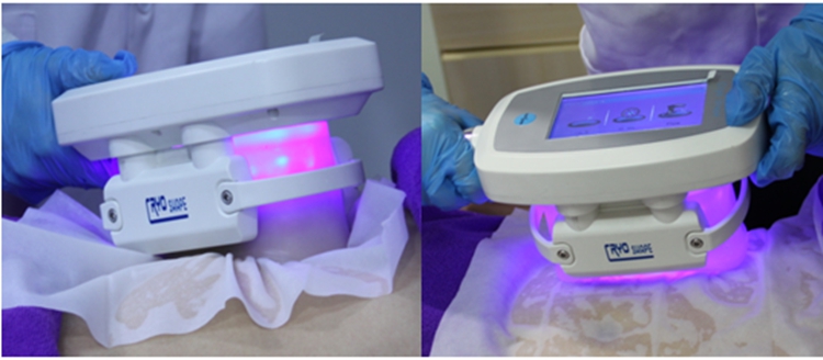 coolsculption body slimming machine